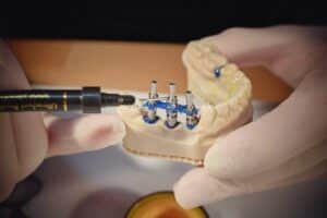 Protetica pe Implant - Aspecte restaurative ale implantologiei orale