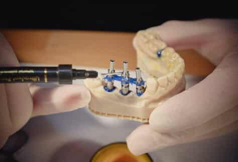 Protetica pe Implant - Aspecte restaurative ale implantologiei orale