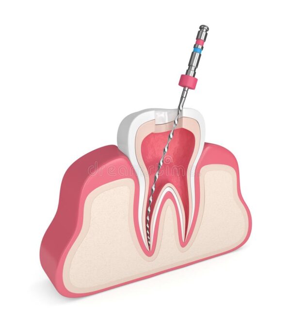 d-render-tooth-endodontic-file-gums-d-render-tooth-endodontic-file-gums-over-white-background-root-canal-129727424